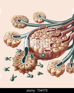 Illustration de la radio-immunothérapie pour traiter le cancer du pancréas. Un isotope radioactif (plomb-212) est combiné avec un anticorps spécifique capable de cibler les cellules cancéreuses. Cette combinaison d'anticorps et de plomb-212 radio-isotope est injecté par voie intraveineuse dans l'organisme jusqu'à ce qu'elle atteigne le pancréas où il se verrouille sur les cellules cancéreuses' antigène. L'initiative détruit les cellules en irradiant. Ce traitement limite la toxicité sur les cellules saines à proximité de la cellules cancéreuses. Banque D'Images