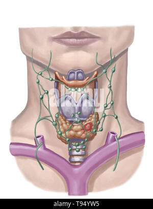 Illustration d'un nodule thyroïdien (en rouge). Ces nodules affectent principalement les femmes et sont pour la plupart bénignes, mais besoin d'être regardé. Banque D'Images