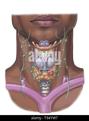 Illustration d'un nodule thyroïdien (en rouge). Ces nodules affectent principalement les femmes et sont pour la plupart bénignes, mais besoin d'être regardé. Banque D'Images