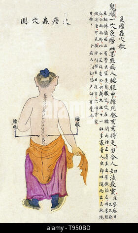 Tableau des points d'ACU-moxa, montrant l'yaoyan lombaire (yeux), point d'Chuanwu lingji lu (Fiche d'Enseignements souverain), par Zhang Youheng, un traité sur l'unité ACU-moxa en deux volumes. Ce travail ne survit que dans un projet de Manuscrit achevé en 1869, (8e année de la période de règne Tongzhi la dynastie Qing). Banque D'Images