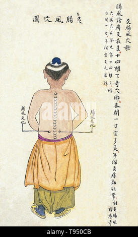 Tableau des points d'ACU-moxa, montrant le vent (intestinale) changfeng point, de Chuanwu lingji lu (Fiche d'Enseignements souverain), par Zhang Youheng, un traité sur l'unité ACU-moxa en deux volumes. Ce travail ne survit que dans un projet de Manuscrit achevé en 1869, (8e année de la période de règne Tongzhi la dynastie Qing). Le texte stipule : Le vent intestinale point est en dessous de la 14e vertèbre, 1 cun d'un côté. La moxibustion à ce point peut guérir, vent intestinal de l'intestin (xiaxue décharge sanglante) et les hémorroïdes chroniques de nombreuses années de la durée. Banque D'Images