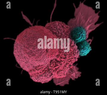 Ce des électrons Microphotographie (SEM) montre un cancer squamous cell orale (rouge), attaquée par deux cellules T cytotoxiques (bleu). La tumeur des cellules T spécifiques ont été élaborés à partir de le propre système immunitaire du patient, un vaccin contre le cancer personnalisé comme ceux qui peuvent être développés dans le futur avec l'aide de génomes humains normalisés du NIST. Cette image a été colorisées. Banque D'Images