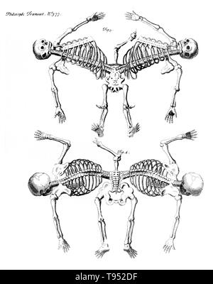 Jumeaux siamois sont de vrais jumeaux nés avec leur corps s'est joint à un moment et d'avoir plus ou moins de résidus de duplication, un résultat de la division incomplète de l'ovule à partir de laquelle les jumeaux mis au point. Les jumeaux Ischiopagus ont fusionné moitié inférieure des deux organes, d'épines jointes bout-en-bout à un angle de 180 degrés. Ces jumeaux ont quatre bras, deux, trois ou quatre pieds ; et, généralement, un ensemble d'organes génitaux féminins externes et l'anus. Droit paru dans "Philosophical Transactions", Volume 32 numéro 377, Firgure 3 & 4, publié 1720-23. Banque D'Images