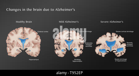 Illustration montrant la progression de la maladie d'Alzheimer. Sur la gauche est un cerveau sain. Le cerveau cortical moyen affiche un retrait, modérément grande ventricules, et d'une réduction de l'hippocampe, les symptômes de la maladie d'Alzheimer légère. Le cerveau droit présente de graves pertes, corticale élargie considérablement des ventricules, et rétrécissement sévère de l'hippocampe, le signe d'une grave maladie d'Alzheimer. Banque D'Images