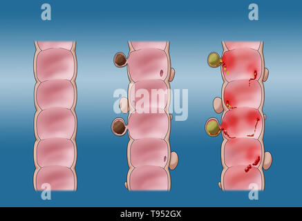 Illustration comparant la diverticulose (milieu) et la diverticulite (droite). Un côlon sain est indiqué sur la gauche. Banque D'Images