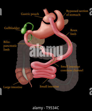 Roux-en-Y Gastric Bypass (mon esprit) est une chirurgie de perte de poids, ou la chirurgie bariatrique, c'est effectué sur les patients qui ont essayé et n'ont pas réussi à perdre du poids perdre en utilisant des méthodes traditionnelles. En Roux-en-Y Gastric Bypass, une petite poche dans la partie supérieure de l'estomac est la seule partie qui reçoit la nourriture, la limitation de l'admission. Le petit intestin est coupé sur une courte distance au-dessous de l'estomac principal et connecté à la nouvelle pochette. L'alimentation découle directement de la poche dans cette partie de l'intestin. Parce que la nourriture maintenant contourne une partie de l'intestin grêle, moins de calories sont absorbés. Banque D'Images