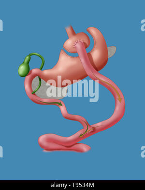 Roux-en-Y Gastric Bypass (mon esprit) est une chirurgie de perte de poids, ou la chirurgie bariatrique, c'est effectué sur les patients qui ont essayé et n'ont pas réussi à perdre du poids perdre en utilisant des méthodes traditionnelles. En Roux-en-Y Gastric Bypass, une petite poche dans la partie supérieure de l'estomac est la seule partie qui reçoit la nourriture, la limitation de l'admission. Le petit intestin est coupé sur une courte distance au-dessous de l'estomac principal et connecté à la nouvelle pochette. L'alimentation découle directement de la poche dans cette partie de l'intestin. Parce que la nourriture maintenant contourne une partie de l'intestin grêle, moins de calories sont absorbés. Banque D'Images