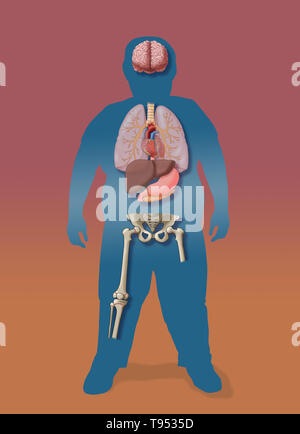 Une illustration de les conséquences médicales de l'obésité chez les enfants. Banque D'Images