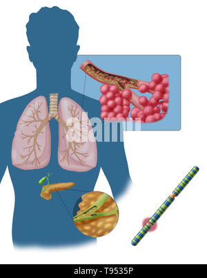 La fibrose kystique (FK) est une maladie génétique qui affecte principalement les poumons, mais aussi le pancréas, le foie, les reins et l'intestin. Les questions à long terme comprennent la difficulté à respirer et cracher le mucus en raison des fréquentes infections pulmonaires. D'autres signes et symptômes peuvent inclure des infections de sinus, une croissance faible, selles grasses, les clubs des doigts et orteils, et l'infertilité chez les hommes. Différentes personnes peuvent avoir différents degrés de symptômes. Banque D'Images