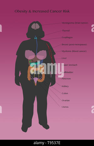 Une illustration montrant les risques de cancer associés à l'obésité. Banque D'Images