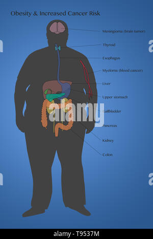 Une illustration montrant les risques de cancer associés à l'obésité. Banque D'Images