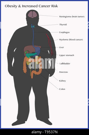 Une illustration montrant les risques de cancer associés à l'obésité. Banque D'Images