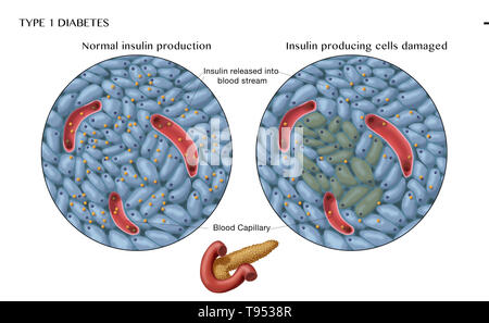 Une illustration montrant la normale (à gauche) et endommagé les cellules productrices d'insuline (à droite) dans le diabète de type 1. Banque D'Images