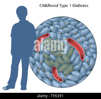Une illustration montrant endommagé les cellules productrices d'insuline dans le diabète de type 1 l'enfance. Banque D'Images