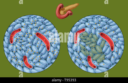 Une illustration montrant la normale (à gauche) et endommagé les cellules productrices d'insuline (à droite) dans le diabète de type 1. Banque D'Images