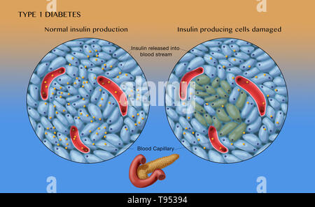 Une illustration montrant la normale (à gauche) et endommagé les cellules productrices d'insuline (à droite) dans le diabète de type 1. Banque D'Images