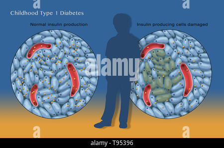 Une illustration montrant la production normale d'insuline (à gauche) et endommagé les cellules productrices d'insuline (à droite) dans le type 1 diabète chez les enfants. Banque D'Images