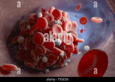 L'inscription d'un caillot de sang formant à l'intérieur d'un vaisseau sanguin. 3D illustration Banque D'Images