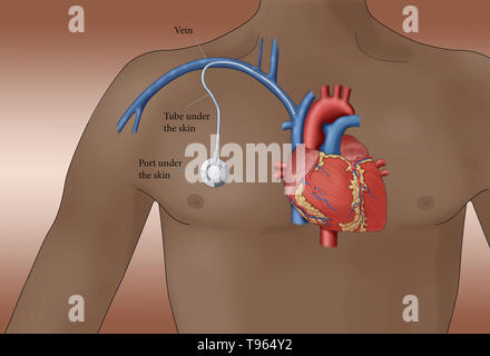 Illustration montrant un port d'accès veineux, un petit appareil médical qui permet d'injecter des médicaments et des échantillons de sang pour être tirée avec moins d'inconfort qu'une aiguille. Banque D'Images