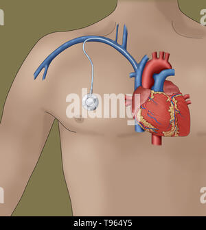 Illustration montrant un port d'accès veineux, un petit appareil médical qui permet d'injecter des médicaments et des échantillons de sang pour être tirée avec moins d'inconfort qu'une aiguille. Banque D'Images