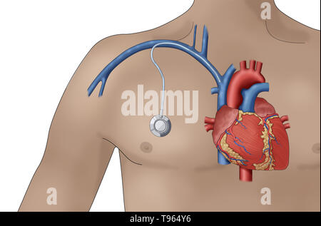 Illustration montrant un port d'accès veineux, un petit appareil médical qui permet d'injecter des médicaments et des échantillons de sang pour être tirée avec moins d'inconfort qu'une aiguille. Banque D'Images