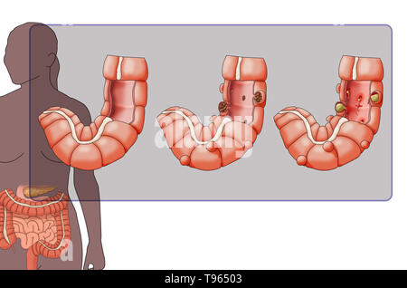 Illustration en comparant l'aspect d'un côlon sain (gauche), diverticulose (milieu), et la diverticulite (droite) ; une silhouette féminine avec le système digestif est mis en évidence dans l'arrière-plan. Banque D'Images
