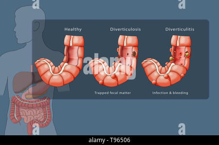 Illustration en comparant l'aspect d'un côlon sain (gauche), diverticulose (milieu), et la diverticulite (droite) ; une silhouette masculine avec le système digestif est mis en évidence dans l'arrière-plan. Banque D'Images