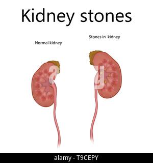 Les calculs rénaux, illustration Banque D'Images