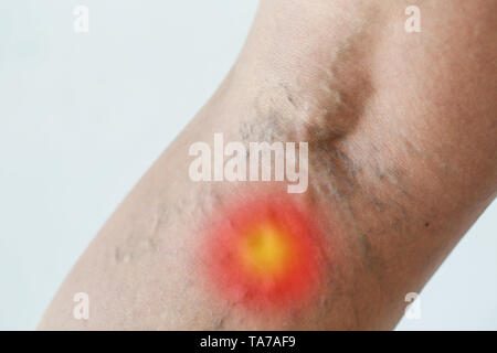 Varices de la jambe avec un point rouge. La médecine, les soins de concept. Banque D'Images