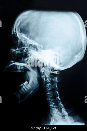 Film x-ray du crâne et de la colonne cervicale vue latérale. Banque D'Images