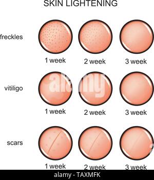 Vector illustration d'allègement de la peau. rousseurs, vitiligo, cicatrices Illustration de Vecteur