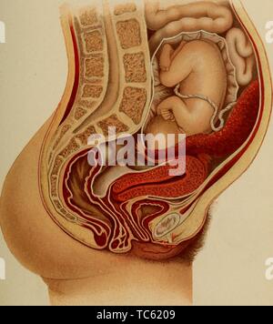 Illustration de la grossesse abdominale secondaire à huit mois, du livre 'Le diagnostic des maladies des femmes" par Findley Palmer, 1905. Avec la permission de Internet Archive. () Banque D'Images