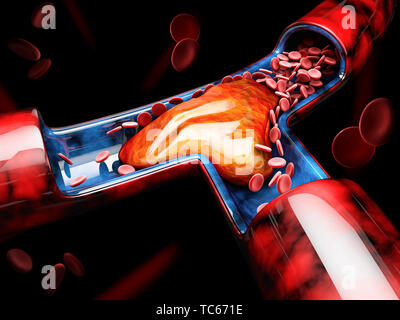3d illustration de la thrombose veineuse profonde ou des caillots de sang. L'embolie. Banque D'Images
