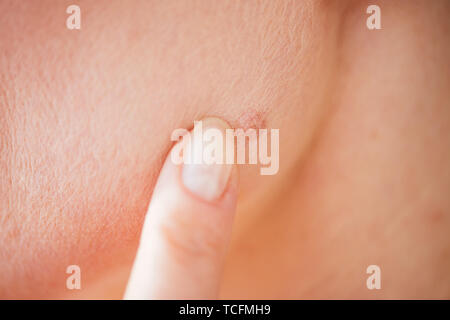 Portrait de femme pointant du doigt avec mole sur la peau Banque D'Images