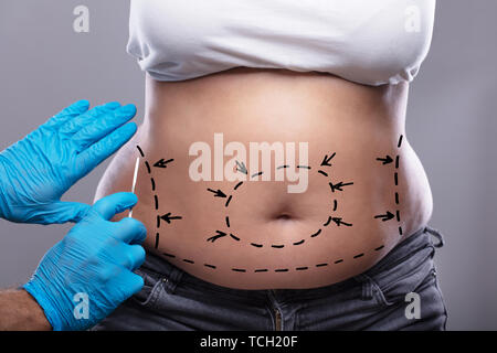 Close-up de chirurgien dans la main Gant bleu tenant un scalpel sur le ventre de femme marquée avec des lignes Banque D'Images