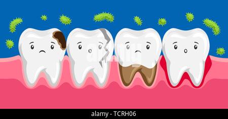 Illustration des dents malades dans la cavité orale. Illustration de Vecteur