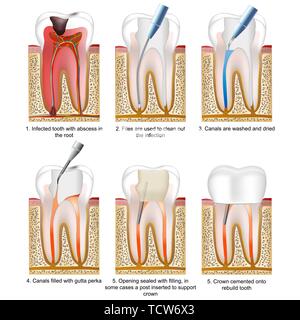 Détruit la carie avec une dent ou un processus d'illustration vectorielle, remplissage des dents Illustration de Vecteur
