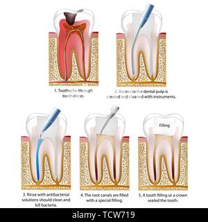 Dents Caries détruit réparé avec une couronne ou une dent d'illustration vectorielle remplissage eps 10 processus Illustration de Vecteur