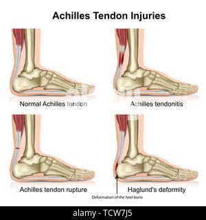 Le tendon d'achille blesse medical vector illustration isolé sur fond blanc avec description en anglais eps 10 Infographie Illustration de Vecteur