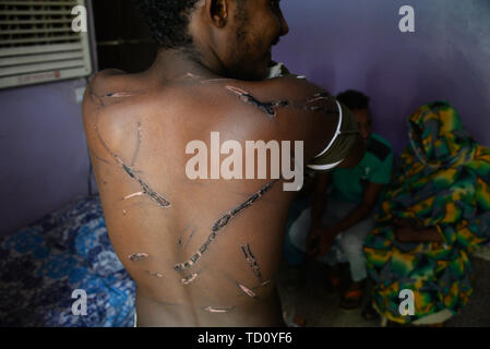 Khartoum, Soudan. 10 Juin, 2019. Ali Idris montre ses blessures. 18-year-old Amar Mohammed al-Hassan et ses amis Abdu al-Rahim et Ali Idris étaient présents la semaine dernière lorsque les forces de sécurité ont brutalement brisé le blocus des sit-in dans le centre de la capitale soudanaise. Des manifestants ont été abattus, battus et chassés, tentes brûlées et les corps jetés dans le Nil. Selon une association médicale, plus de 100 personnes sont mortes. (Dpa 'Revolution au Soudan : 'il vient de commencer') Credit : Gioia Forster/dpa/Alamy Live News Banque D'Images