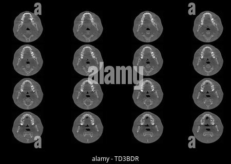 Ensemble de scanner IRM de tranches de la partie dentaire des droits de l'homme godille avec de multiples problèmes sur fond blanc. Banque D'Images