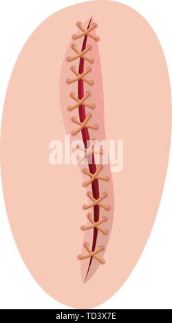 L'icône de suture de l'incision. Caricature de suture incision icône vecteur pour la conception web isolé sur fond blanc Illustration de Vecteur