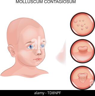 Vector illustration de Molluscum contagiosum chez un enfant. Illustration de Vecteur