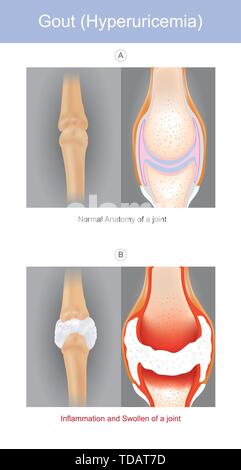 L'illustre une forme d'arthrite qui peuvent être intensément douloureux il est causé par des cristaux d'urate de sodium dans les articulations d'une main avec les doigts ou les orteils. Illustration de Vecteur