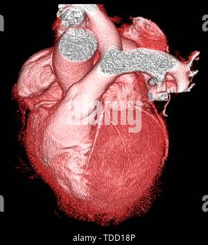 Coeur en santé, scanner 3D Banque D'Images
