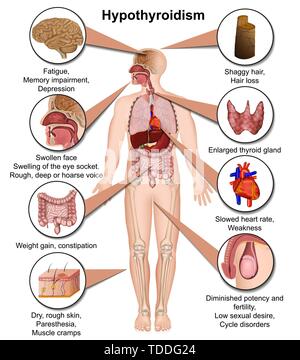 Vector illustration médicale hypothyroïdie isolé sur fond blanc infographie Illustration de Vecteur