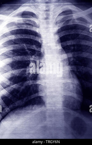 Close up image of X-ray de la poitrine Banque D'Images