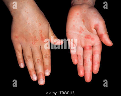 Enfant avec des taches rouges de Coxsackievirus, sur les deux mains, Palm, et de dos, isolé sur fond noir Banque D'Images