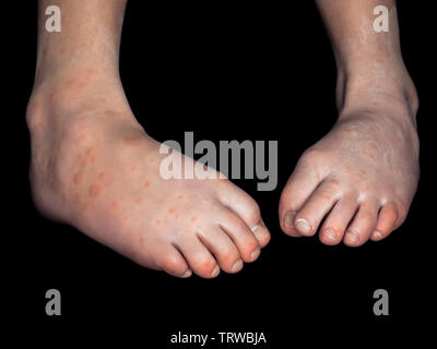 Enfant avec des taches rouges de Coxsackievirus, sur les deux pieds, isolé sur fond noir Banque D'Images