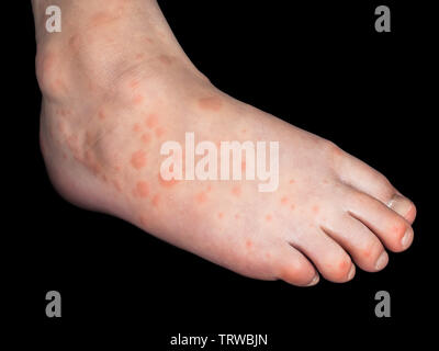 Enfant avec des taches rouges de Coxsackievirus, sur le pied droit, isolé sur fond noir Banque D'Images